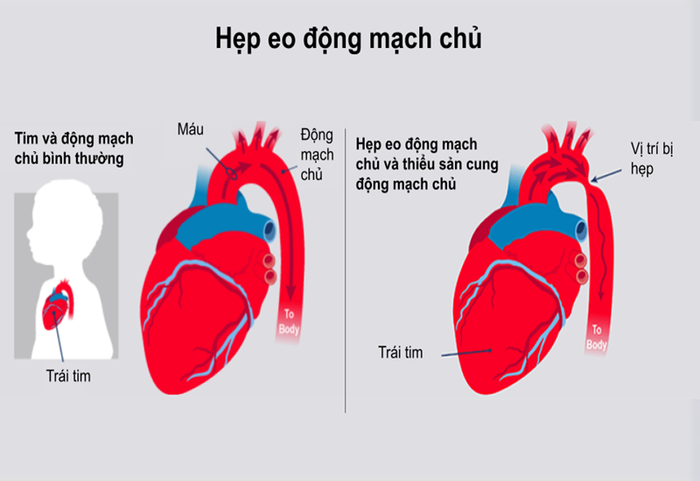 Hẹp eo động mạch chủ: Một nguy hiểm đối với sức khỏe