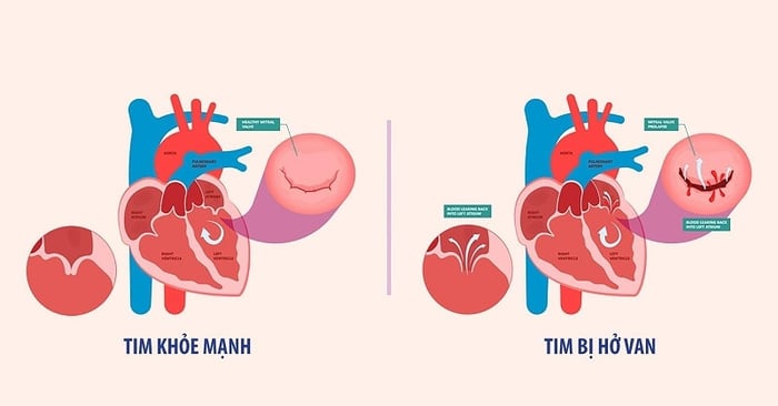 Tình trạng van tim hở gây ra hiện tượng máu chảy ngược vào khoang trước đó.