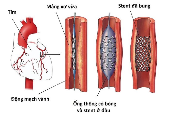 Phòng ngừa bệnh động mạch vành rất quan trọng