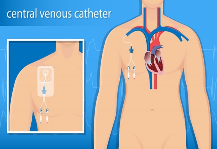 Việc đặt catheter tĩnh mạch trung tâm mang lại nhiều lợi ích