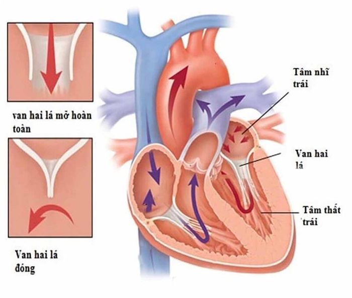 Mở van hai lá gây ra sự phản xạ ngược của máu về buồng tim sau khi được bom ra ngoài