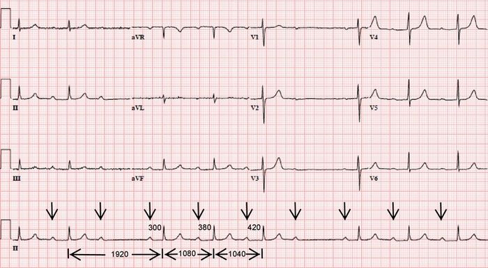 Block nhĩ thất thường chỉ được phát hiện qua điện tâm đồ