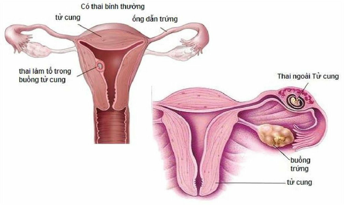 Nếu không chẩn đoán kịp thời, thai ngoài tử cung có thể gây ra những biến chứng nguy hiểm.