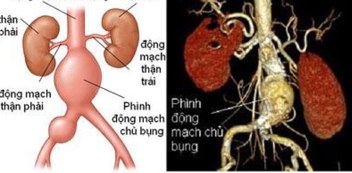 Hình Ảnh Miêu Tả Về Chứng Phình Động Mạch Chủ Bụng