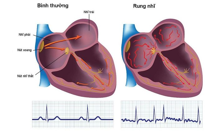 Rối loạn nhịp tim trong bệnh rung nhĩ