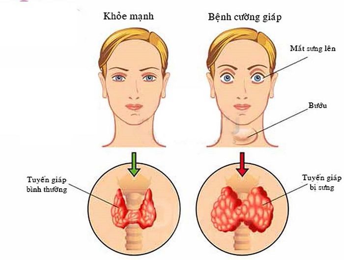 Người mắc cường giáp thường có cảm giác hồi hộp, nhịp tim nhanh hơn bình thường.