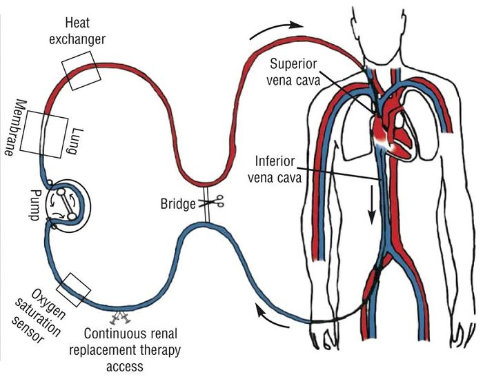 ECMO là một thiết bị thay thế cho chức năng tim phổi tự nhiên