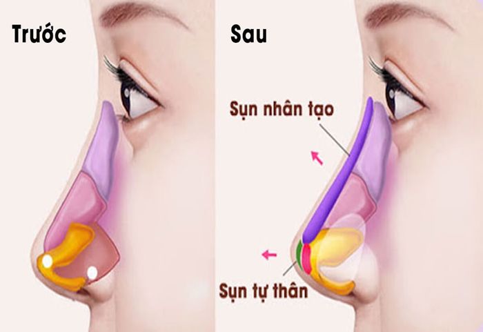 Sụn tự thân và sụn nhân tạo là 2 loại sụn phổ biến trong kỹ thuật nâng mũi