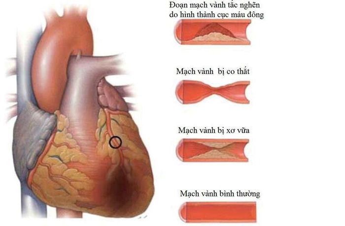 Bệnh thiếu máu cơ tim thường do hẹp tắc mạch vành