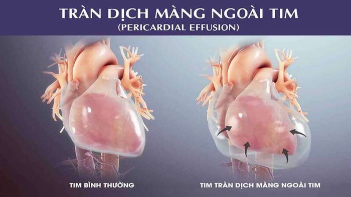 Tình trạng tích tụ dịch ở màng ngoài tim rất nguy hiểm