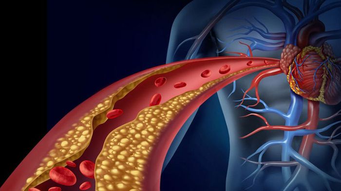 Sự tích tụ cholesterol trong hệ tuần hoàn làm tăng nguy cơ mắc cơn đau tim cấp