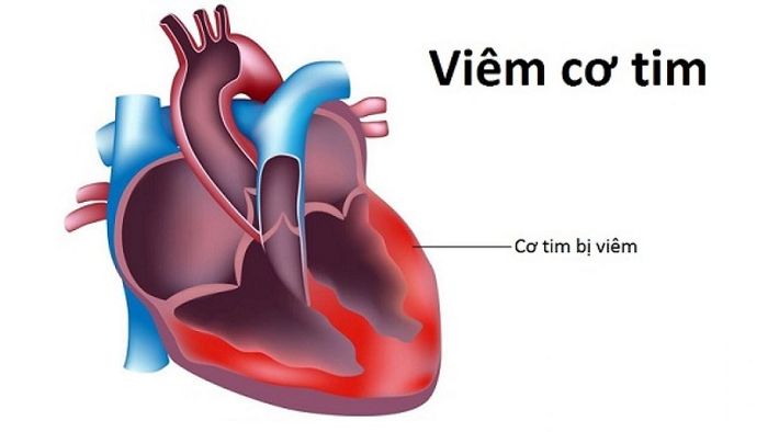 Viêm cơ tim là một trong những nguyên nhân gây ra sự chậm trễ trong nhịp tim.