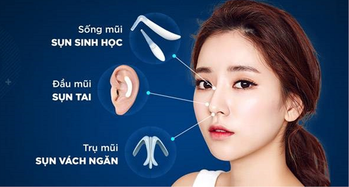 Sụn tự thân có khả năng tương thích cao, ít gây biến chứng.