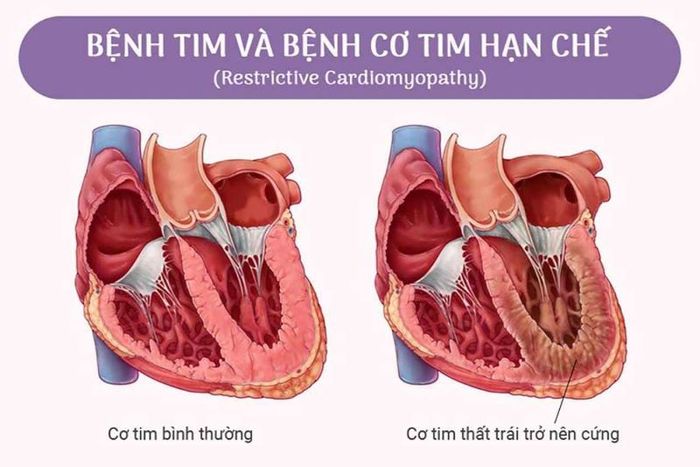 Nguy cơ mắc bệnh tim hạn chế