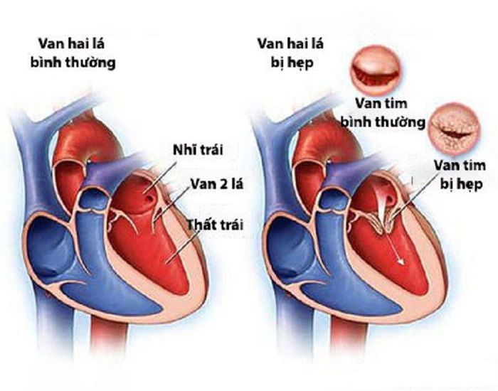 Siêu âm tim giúp phát hiện các tình trạng hẹp van tim.