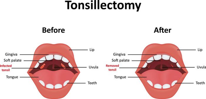 Việc phẫu thuật loại bỏ amidan được coi là biện pháp tốt nhất trong thời điểm hiện tại