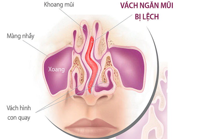 Vấn đề về mũi lệch vách ngăn