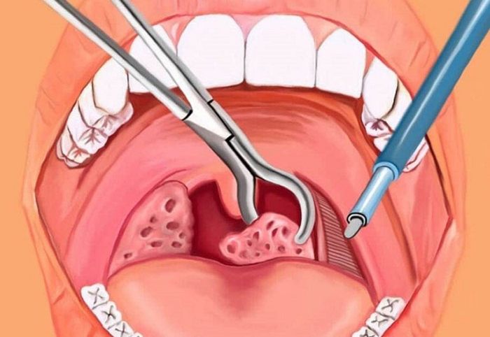 - Người có tiền sử phẫu thuật áp xe xung quanh amidan ít nhất một lần.