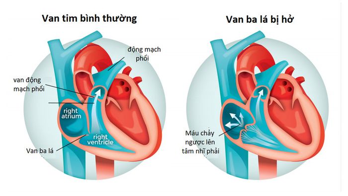 Van tim bệnh lý là nguyên nhân dẫn đến huyết áp kẹt