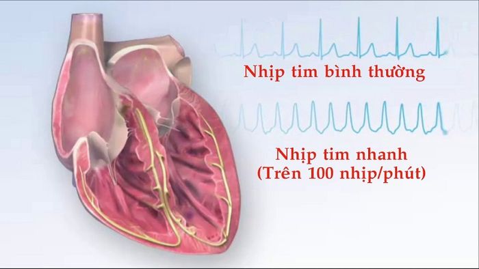 Khi nhịp tim vượt quá 100 lần/phút, được xem là nhịp tim nhanh.