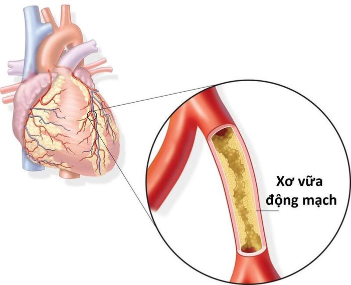 Mỡ máu cao là nguyên nhân chủ yếu gây xơ vữa động mạch trong 70% trường hợp nhồi máu cơ tim