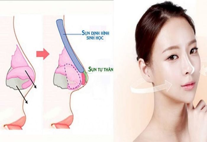 Sụn tự thân có khả năng tương thích rất tốt