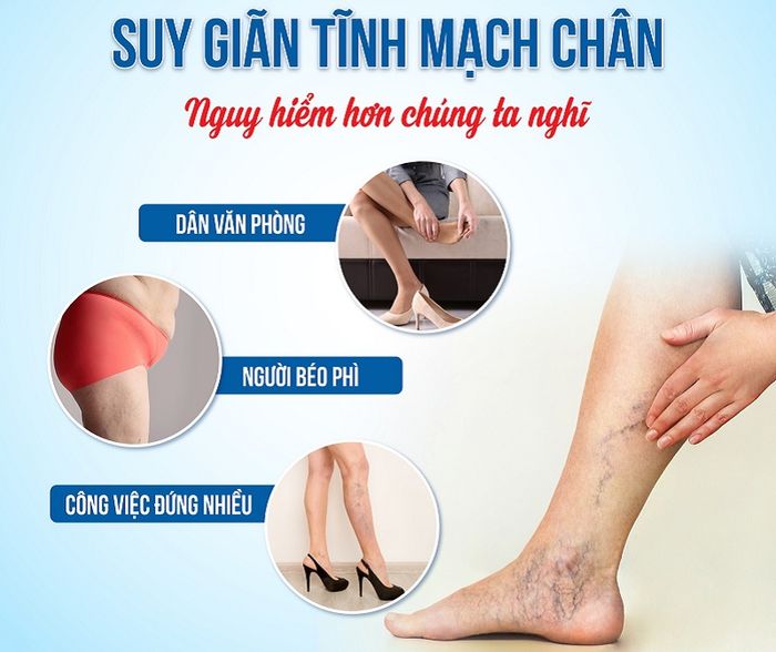 Thông Tin Cần Biết về Suy Giãn Tĩnh Mạch