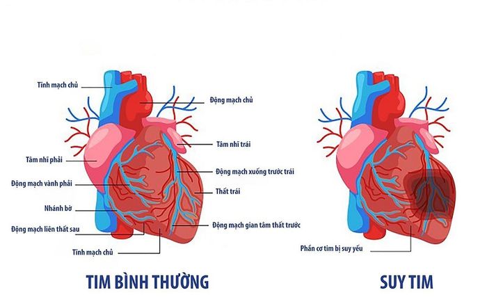 Suy tim là một bệnh lý nguy hiểm, đe dọa trực tiếp đến tính mạng.