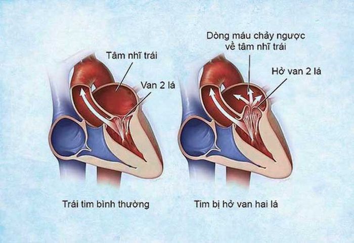 Hình ảnh mô phỏng quả tim bị hở van hai lá