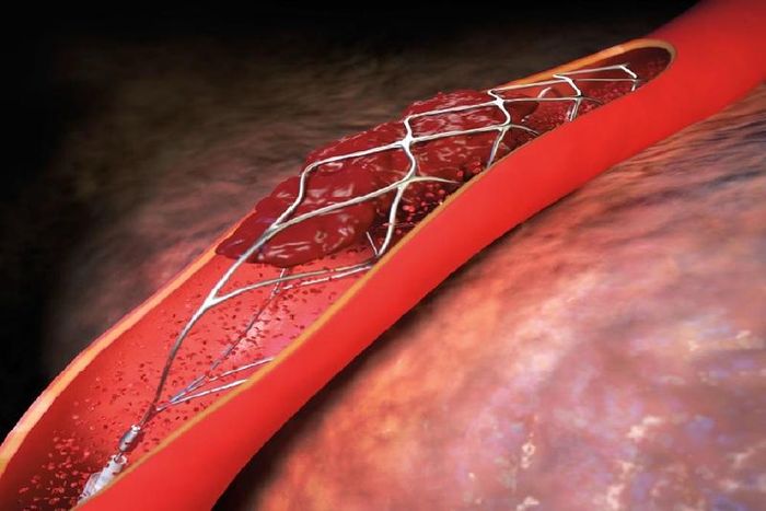 Sử dụng stent là biện pháp hữu ích trong việc cải thiện tình trạng bệnh mạch vành cho phần lớn các trường hợp.