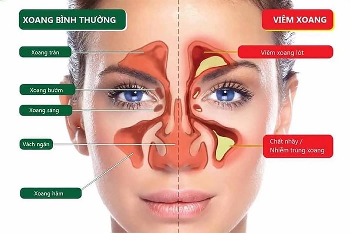 Viêm xoang dẫn đến sự tích tụ dịch nhầy và gây mùi hôi ở mũi