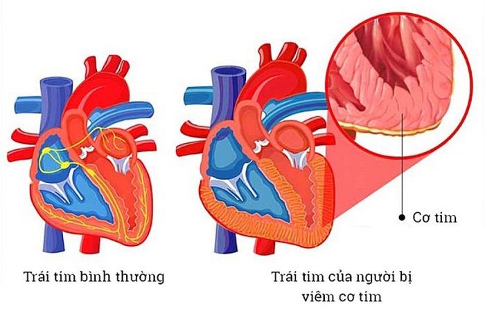 Không nên coi thường nguy hiểm từ viêm cơ tim.