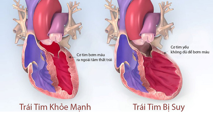 Suy tim tâm thu xảy ra khi chức năng bơm máu của tim giảm sút