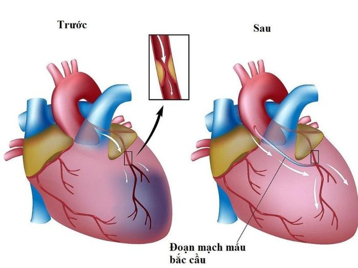 Lưu thông máu không được tốt khi động mạch vành bị hẹp