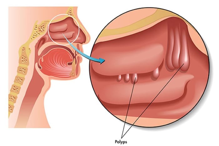 Một bên cánh mũi sưng phồng có thể do sự phát triển của khối polyp trong mũi.