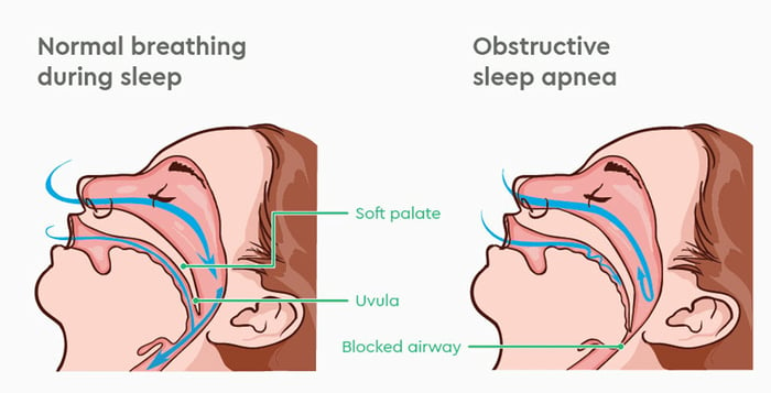 Định nghĩa ngưng thở tắc nghẽn khi ngủ