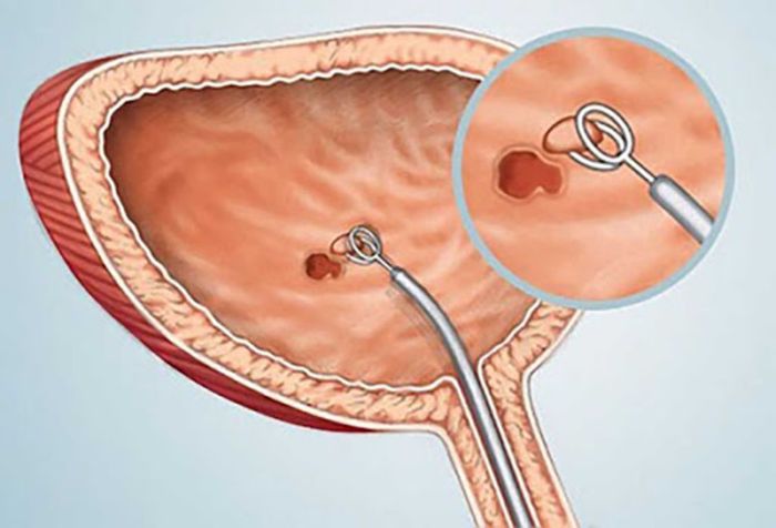 Y học vẫn chưa hiểu rõ nguyên nhân và cơ chế gây ra viêm bàng quang trong những trường hợp này