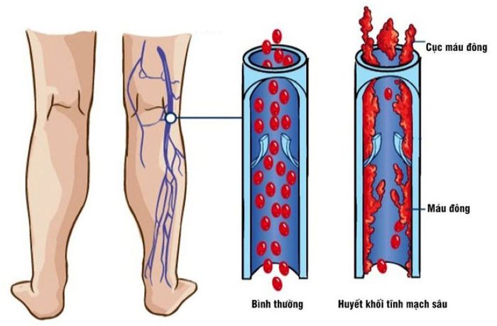 “Bệnh chạy bộ” nếu không được điều trị sớm có thể dẫn đến hình thành huyết khối tĩnh mạch