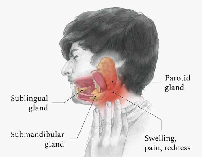 Viêm tuyến nước bọt có nguy hiểm không?