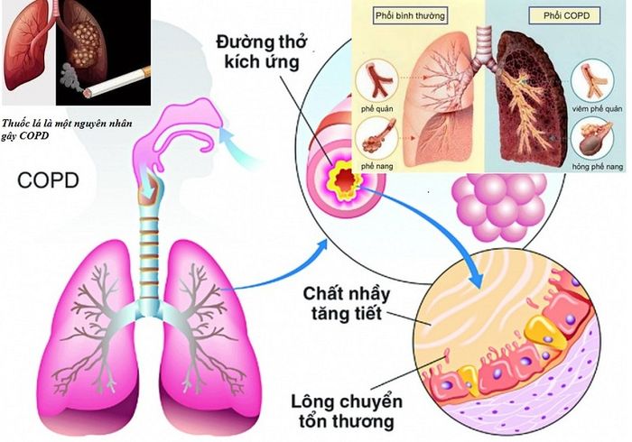 Những người mắc tắc nghẽn phổi mãn tính cũng có thể gặp phải các triệu chứng như khó thở và tim đập mạnh