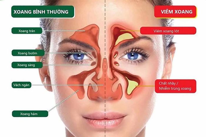 Viêm xoang không được chữa trị kịp thời có thể dẫn đến những biến chứng nguy hiểm