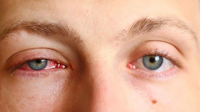 Viêm xoang có thể dẫn đến viêm mắt, là một trong những biến chứng phổ biến
