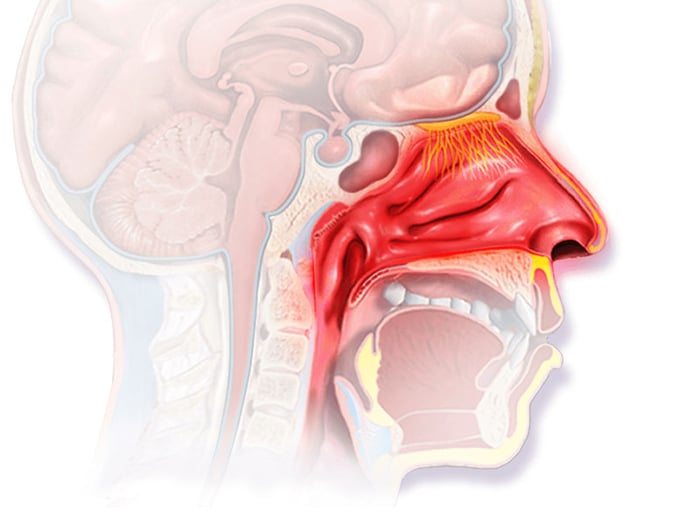 Viêm mũi dị ứng không theo chu kỳ gây ra nhiều vấn đề về hô hấp và cấu trúc vùng mũi