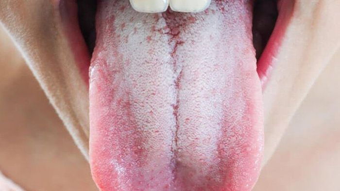 Lưỡi bị nứt và nổi nốt