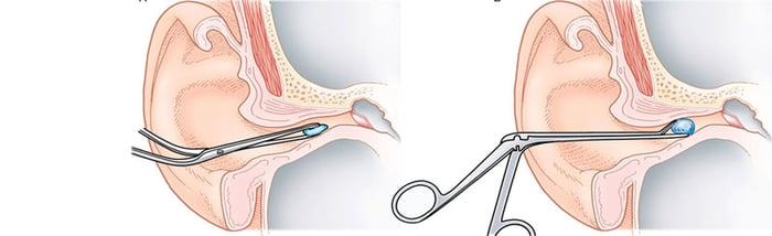 Người bị dị vật kẹt trong tai nên đến bác sĩ chuyên khoa để được điều trị