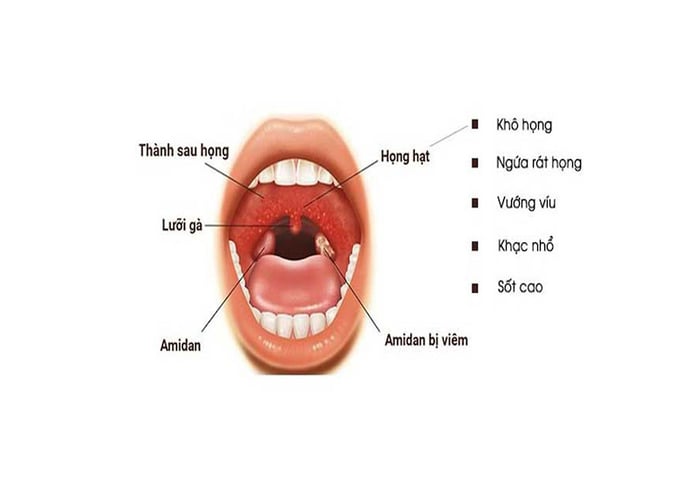 Viêm họng là một nguyên nhân phổ biến gây ho rát họng có đờm.