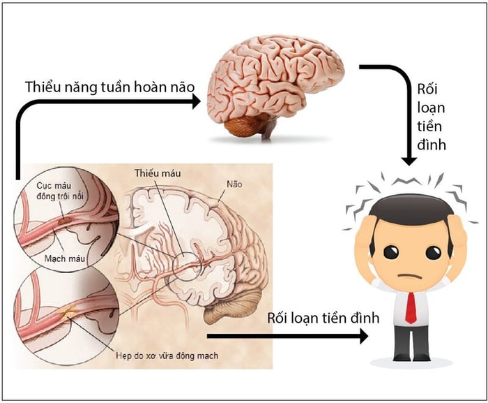 Rối loạn tiền đình là một trong những nguyên nhân gây ra chóng mặt và ù tai