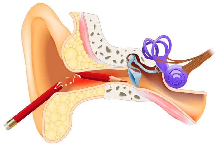 Dị vật trong tai gây ra cảm giác không thoải mái và đau đớn