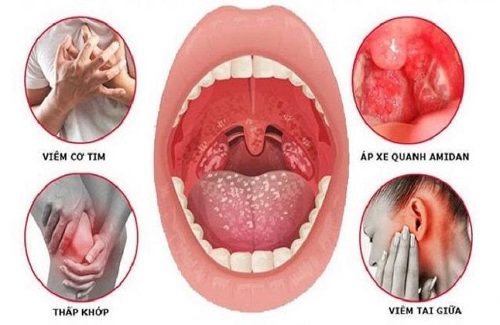 Các biến chứng do viêm amidan kéo dài không được điều trị