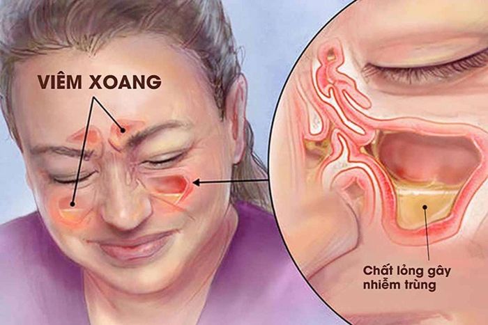 Tại sao viêm xoang gây đau đầu?